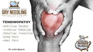 Tendinitis and Tendinopathy Dry Needling Treatment Protocol [upl. by Osicran]