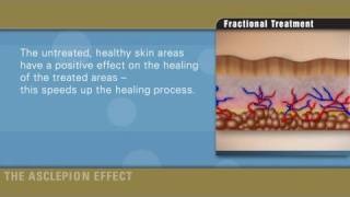 Fractional therapy with Erbium laser by Asclepion [upl. by Akceber]