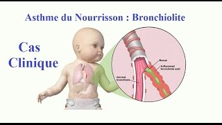 Bronchiolite Asthme du Nourrisson Cas Clinique [upl. by Serrell]