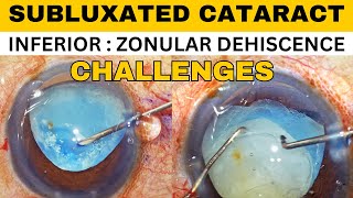 Subluxated Cataract Phacoemulsification  CTR insertion  Dr Deepak Megur [upl. by Archangel225]