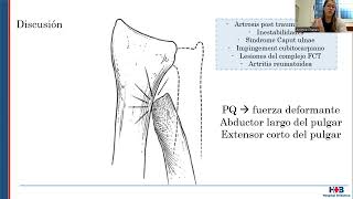 Tratamiento de la inestabilidad del muñón distal en cirugías de Darrach fallidas [upl. by Duquette659]