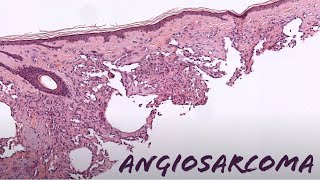 Angiosarcoma under the microscope explained in 5 minutes pathology dermpath dermatology [upl. by Hamel404]