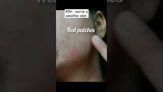 How to know sensitive skin type  sensitive skin kaisi hoti hai shorts youtubeshorts [upl. by Niwle]