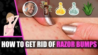 Razor bumps  How to get rid of razor bumps  Get rid of razor burns [upl. by Baerl]