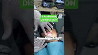 LASER GUM SURGERY dentist hyderabad dental gumsurgery laser [upl. by Ara178]