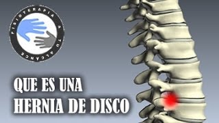 Hernia discal que es y como se produce [upl. by Karlik]