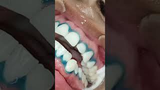 Appliquer du gel de blanchiment des dents [upl. by Azne]