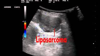 Liposarcoma [upl. by Betta]