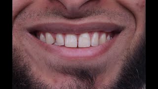 Multiple diastema closure with composite resin [upl. by Annodal]