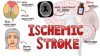 Acute Ischemic Stroke  Signs and Symptoms Stroke Syndromes  Causes amp Mechanisms  Treatment [upl. by Asert]