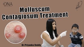 How to treat Molluscum Contagiosum  Treatment of viral skin infection  Dr Priyanka Reddy [upl. by Bailey289]