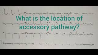 ECG spotter 8 [upl. by Groveman888]