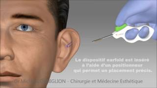 Earfold  une technique non chirurgicale pour les oreilles décollées  Dr Corniglion [upl. by Michaele]