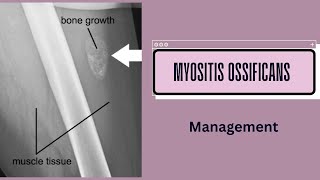 Management of Myositis Ossificans [upl. by Toy]