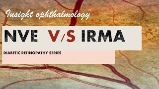 IRMA vs NVE  intraretinal microvascular abnormality vs neovascularisation [upl. by Anole]