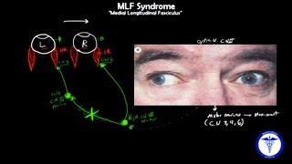 MLF syndrome  Internuclear Ophthalmoplegia MADE EASY [upl. by Ennaisoj]