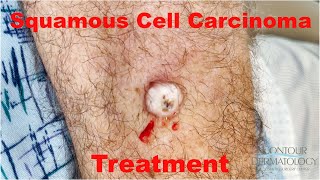 Squamous Cell Carcinoma treated via Electrodessication and Curettage  CONTOUR DERMATOLOGY [upl. by Alva8]