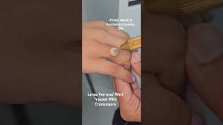 Treatment of one month old wart on the ring finger with Cryosurgery wart verruca dermatologist [upl. by Hewes]