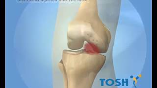 Stemcell Knee Cartilage Regeneration Treatment for Knee Arthritis  Tosh Hospital Chennai India [upl. by Rammaj671]