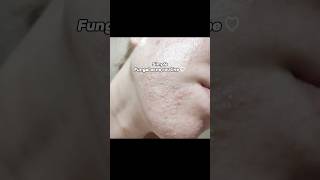 Simple Fungal acne routine fungalacne fungalacneroutine skincare shorts videosIneed [upl. by Frazer]