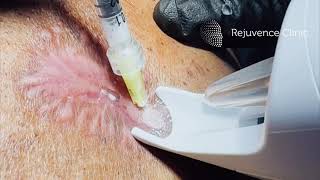 Intralesional steroid injections for keloid scars on the body rejuvenceclinic91 [upl. by Irod836]