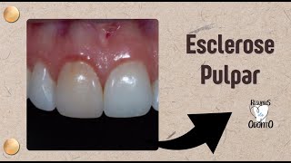 ESCLEROSE PULPAR  RESUMOS DE ODONTO [upl. by Hsirrehc]