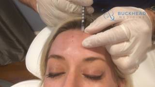 Botox Forehead Injection Treatment [upl. by Trixy15]