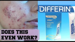 I TRIED DIFFERIN GEL FOR ONE WEEK AND THIS IS THE RESULTS  Review on Adapalene Gel [upl. by Katlaps]