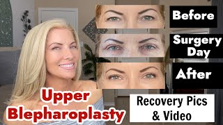 Upper Blepharoplasty Eyelid Surgery  Recovery Pics and Videos  Before amp Afters [upl. by Swee]