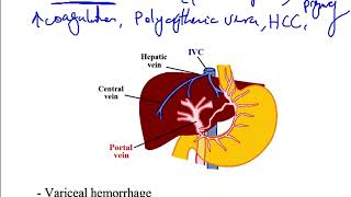 USMLE ACE Video 163 Oncotic and Hydrostatic Pressures Liver Cirrhosis and BuddChiari Syndrome [upl. by Ennaillij]