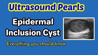 Ultrasound Pearls Epidermal inclusion cyst [upl. by Ainitsirc]