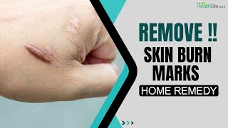 Skin Burn Marks Home Remedies 5 Hacks To Get Rid Of Burn Marks At Home  Skincare Tips [upl. by Accber]