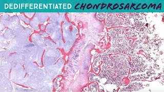 Dedifferentiated Chondrosarcoma with osteosarcoma heterologous area  hemipelvectomy UNC case 7 [upl. by Waldemar]