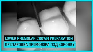 Lower premolar crown preparation Препаровка нижнего премоляра под коронку [upl. by Gemina937]