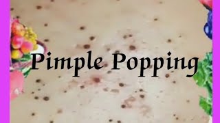 Pimple amp Blackheads Popping  52 [upl. by Wren660]