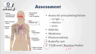 Lupus SLE NCLEX® Review  NRSNGacademycom [upl. by Keavy558]