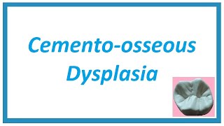 Cementoosseous Dysplasia  Important Notes  Diseases of Bone and Joint 4  Oral Pathology [upl. by Hurlbut803]