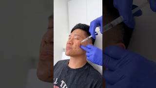 Injections and lasers for my acne scars [upl. by Donald367]