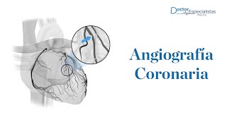 Angiografía coronaria en Guadalajara  Doctores Especialistas [upl. by Epner]