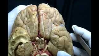 NEUROANATOMÍA 20 DISECCIÓN DE LA CARA VENTRAL DEL ENCÉFALO LÓBULO TEMPORAL 1 [upl. by Irami]