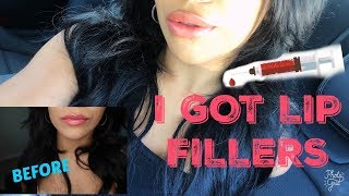 MY FIRST TIME JUVEDERM VOLLURE LIP FILLERS [upl. by Grani]