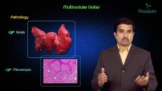 Multinodular goitre  Usmle step 1 pathology lecture and case presentation [upl. by Eta294]