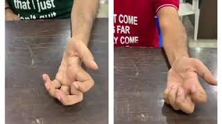 Forearm rotation before and after treatment of Amyotrophic Lateral Sclerosis ALS [upl. by Idnek55]