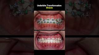 Underbite braces transformation braces orthodontist dentist bracket [upl. by Ddat800]