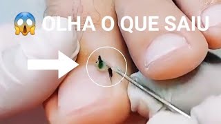 ðŸ”´ OLHA O QUE TINHA NESTA UNHA  unhas podologia unhaencravada [upl. by Magas]