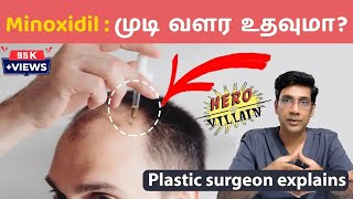 முடி வளர்ச்சிக்கு மினாக்ஸிடில் எப்படி பயன்படுத்துவது Minoxidil  Hair Loss clinic coimbatore [upl. by Hallett]