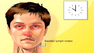 Why Lymph Nodes Swell Animation  Lymphatic System Structure amp Function Anatomy amp Physiology Video [upl. by Seyah]