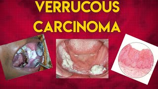 VERRUCOUS CARCINOMA [upl. by Hazlett]