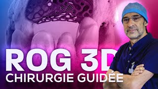 Chirurgie implantaire guidée après ROG 3D [upl. by Siekram]