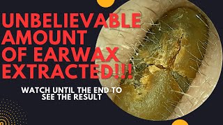 UNBELIEVABLE Amount Of Earwax Extracted From This Ear Watch Until The End [upl. by Joanne]